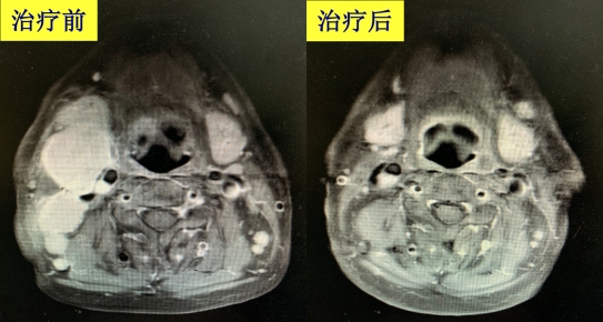 关于颈部包块，这些知识你要“码住”