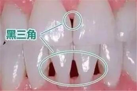 牙龈萎缩